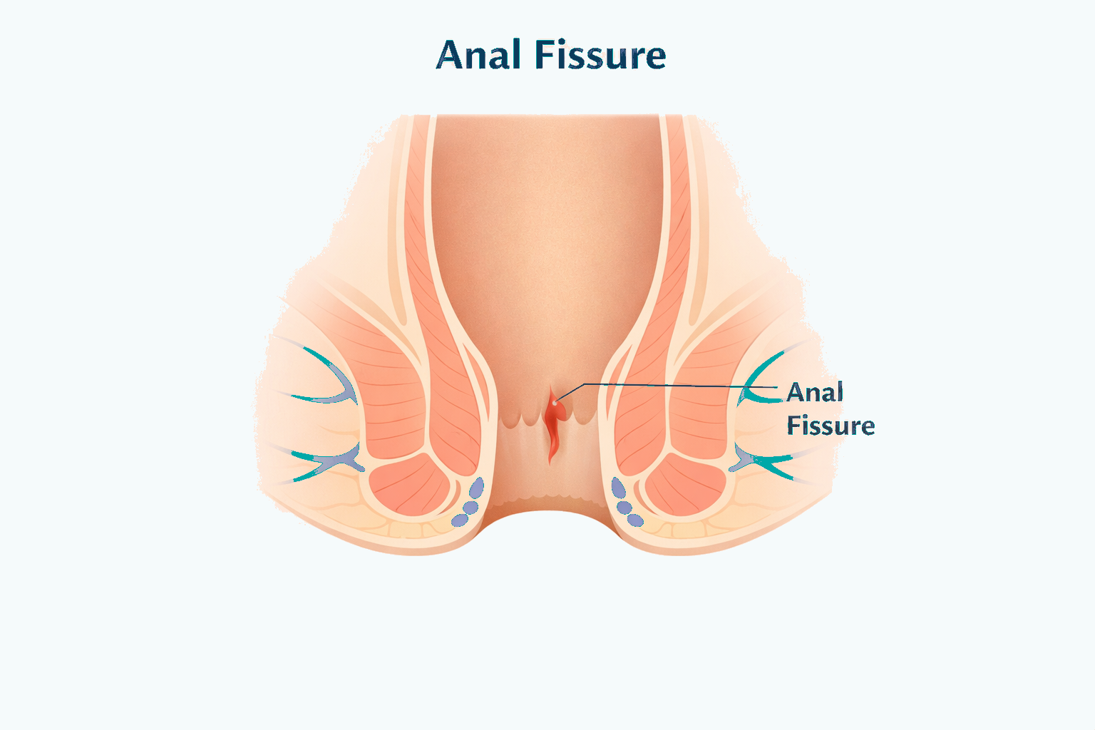 Anal Fissure