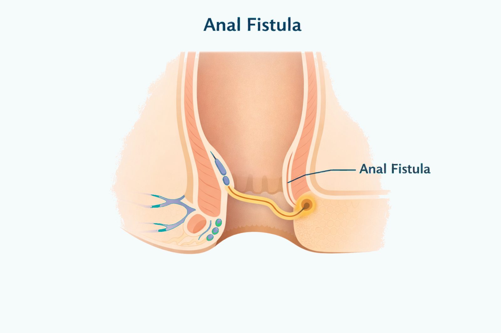 Anal Fistula