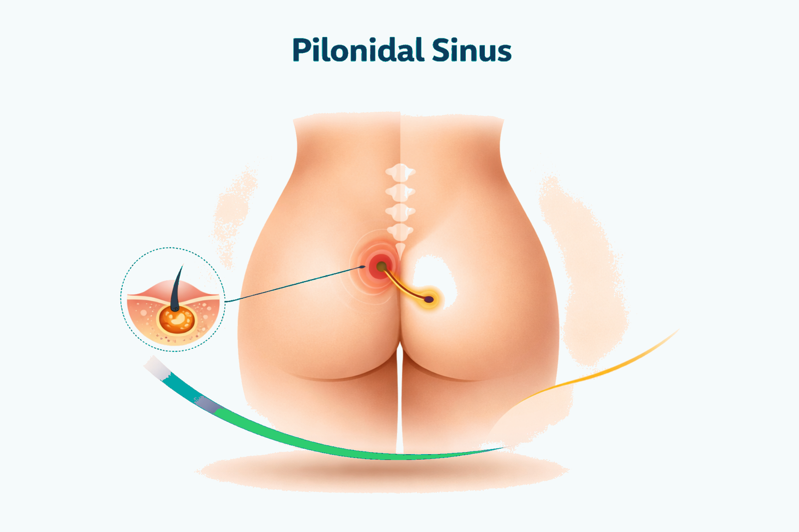 Pilonidal Sinus